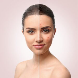 Laser toning before and after Balaji Skin Clinic