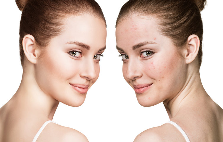 acne treatment by best Dermatologist Dr Sandeep Gupta