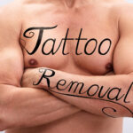 Tattoo Removal