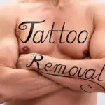 Tattoo Removal