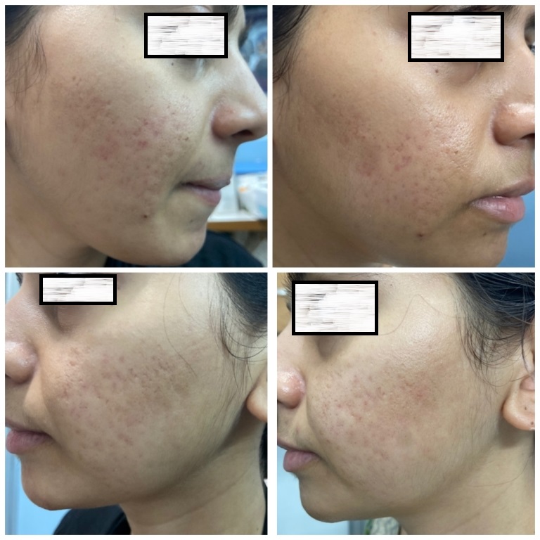 Acne Scars Treatment