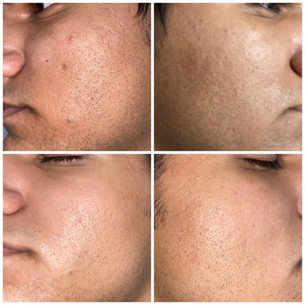 Acne Scars Treatment