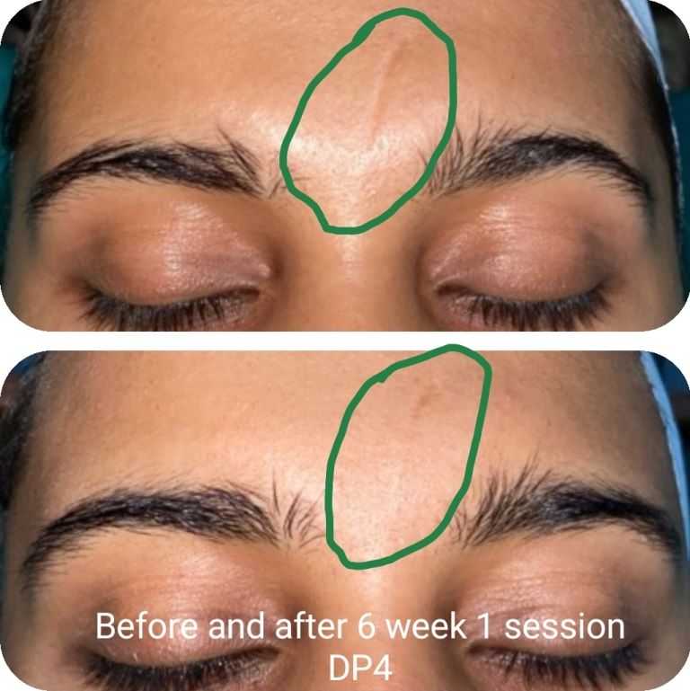 Dermapen 4 scar reduction