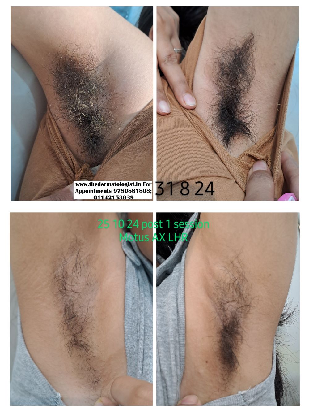 Underarm laser hair Reduction