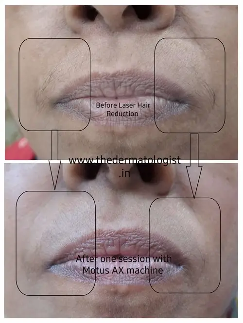 Upper Lip Laser Hair Reduction