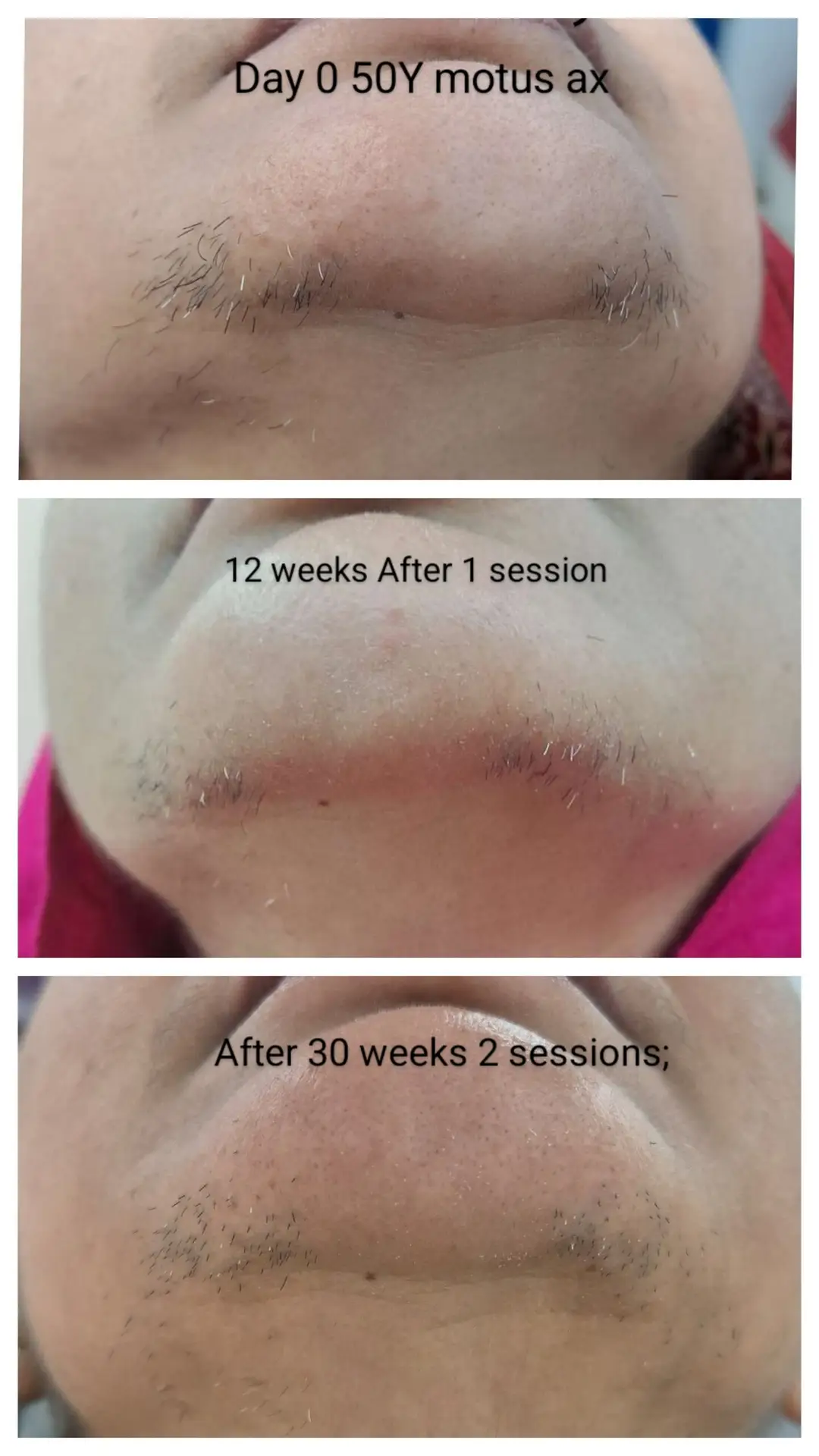 Laser hair reduction Chin