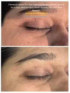 Chemical cautery immediately after skin tags