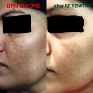 Multiple DPN or small skin tags removad by Radifrequency