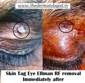 Skin tag eyelid