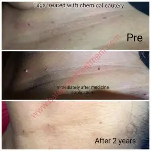 Skin Tags Chemical Cautery
