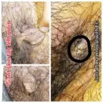 Large-tag-groin-RF-removal