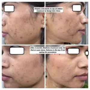 4 months acne treatment medicine 1