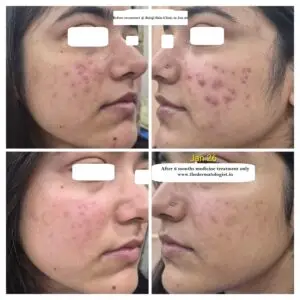 acne 6 months