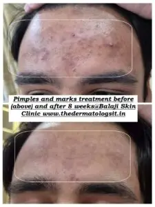 acne forehead 1