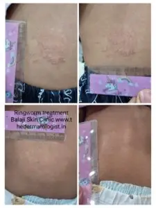 back tinea
