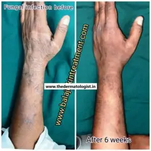 tinea manuum 23 4 22 1