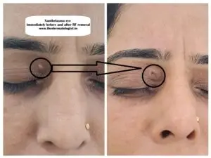 Xanthelasma RF treatment