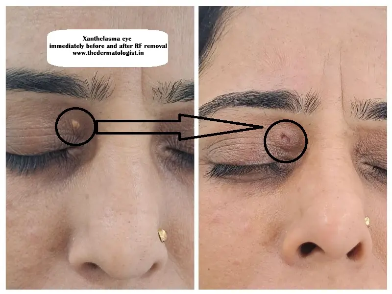 Xanthelasma RF treatment