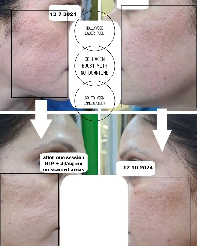 Depressed Scars treatment by Spectra Xt