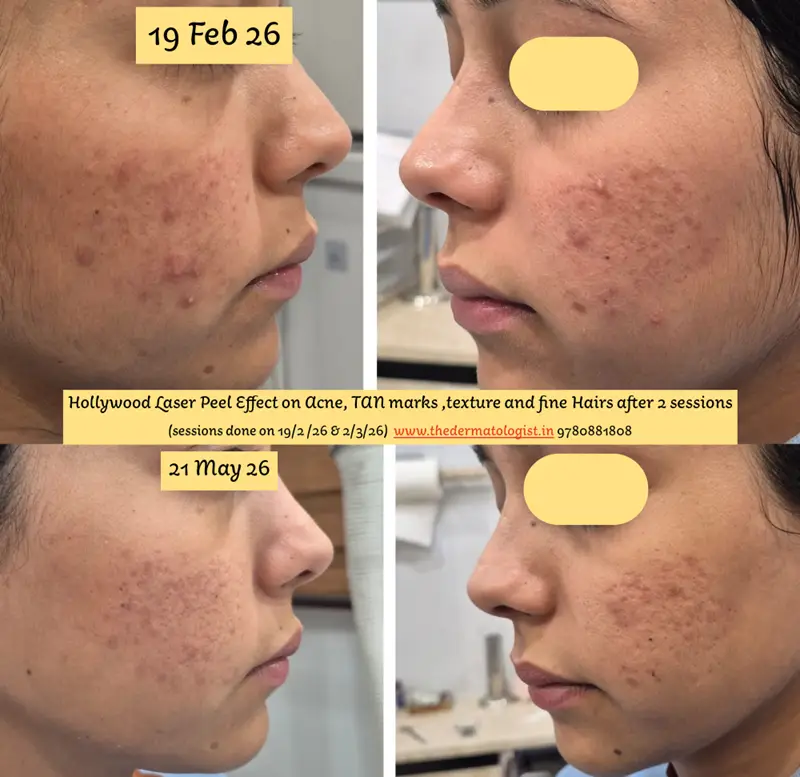 Hollywood LAser Peel Acne 2 sessions