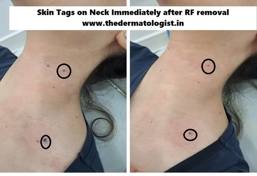 tag neck