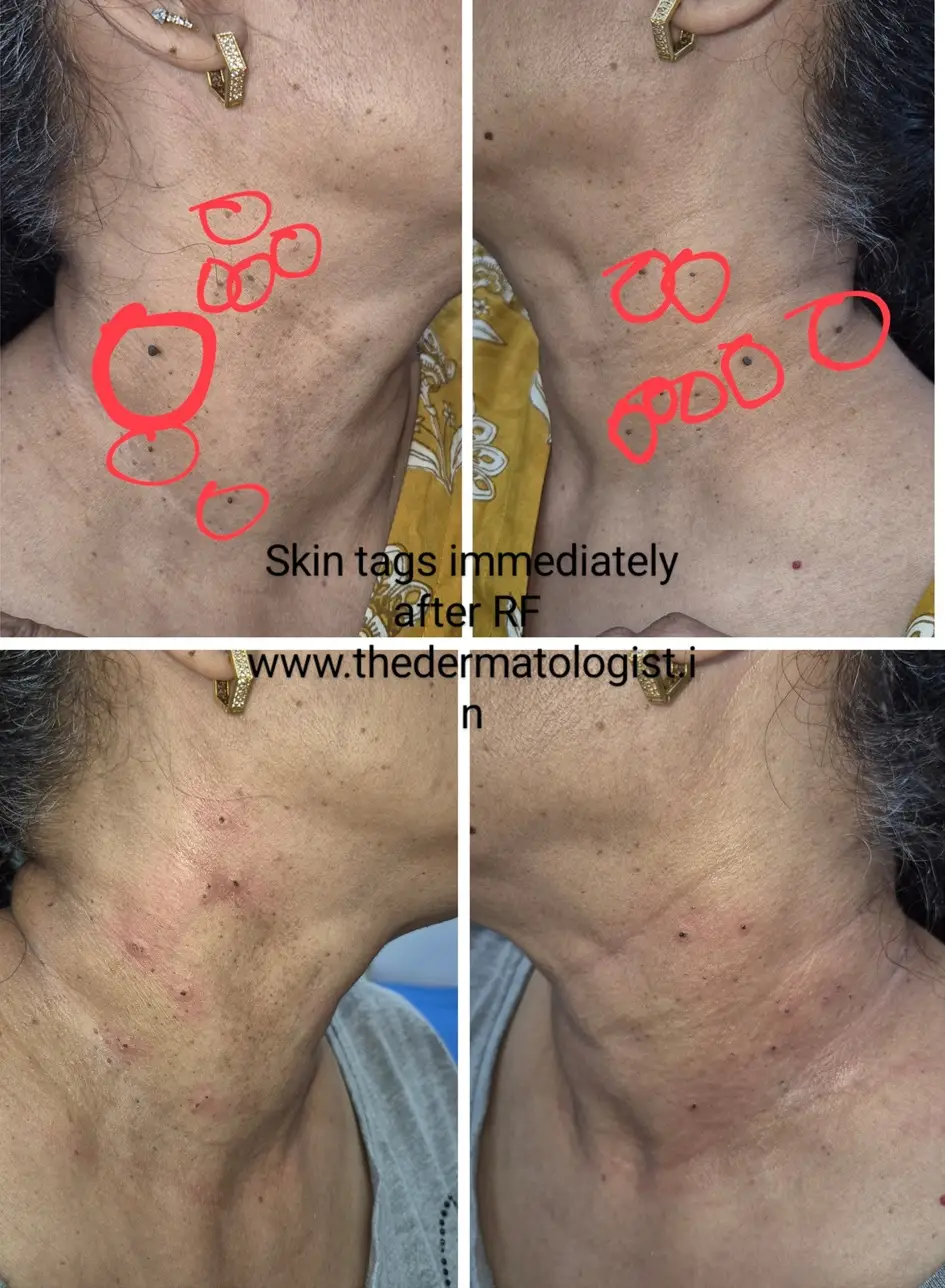tags imm after rf neck
